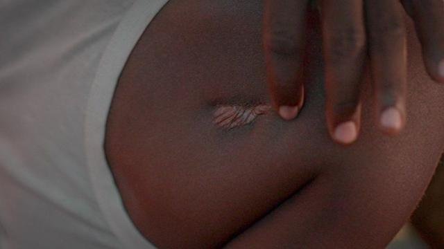 La cicatriz de Ahmat en el hombro