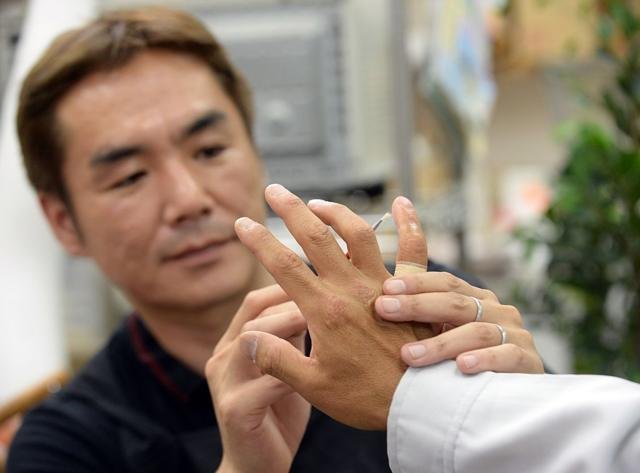 Reconstrucción de meñique en Japón